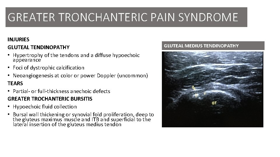 GREATER TRONCHANTERIC PAIN SYNDROME INJURIES GLUTEAL TENDINOPATHY • Hypertrophy of the tendons and a