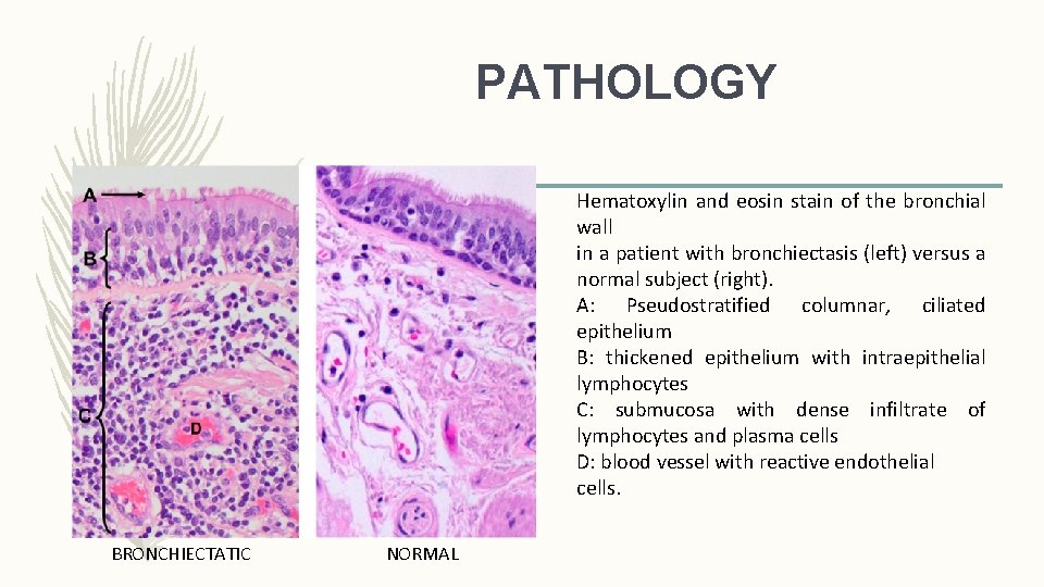 PATHOLOGY Hematoxylin and eosin stain of the bronchial wall in a patient with bronchiectasis