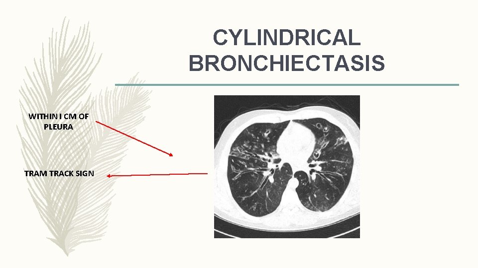 CYLINDRICAL BRONCHIECTASIS WITHIN I CM OF PLEURA TRAM TRACK SIGN 