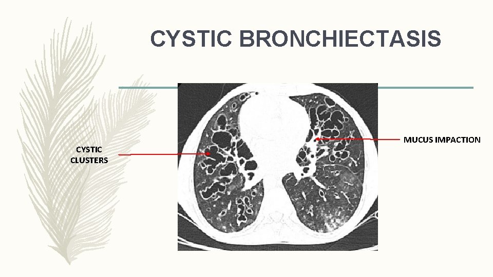 CYSTIC BRONCHIECTASIS CYSTIC CLUSTERS MUCUS IMPACTION 