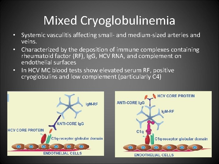 Mixed Cryoglobulinemia • Systemic vasculitis affecting small- and medium-sized arteries and veins. • Characterized