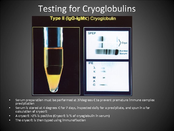 Testing for Cryoglobulins • • Serum preparation must be performed at 37 degrees C