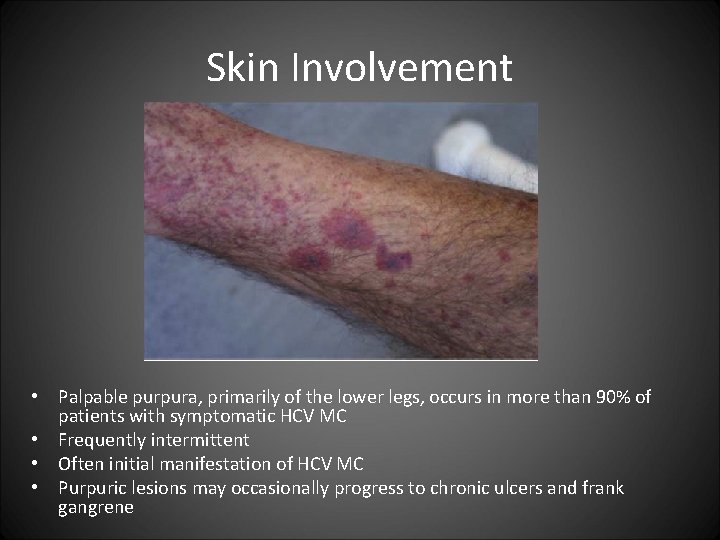Skin Involvement • Palpable purpura, primarily of the lower legs, occurs in more than