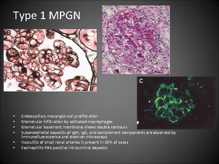 Type 1 MPGN • • • Endocapillary mesangial-cell proliferation Glomerular infiltration by activated macrophages