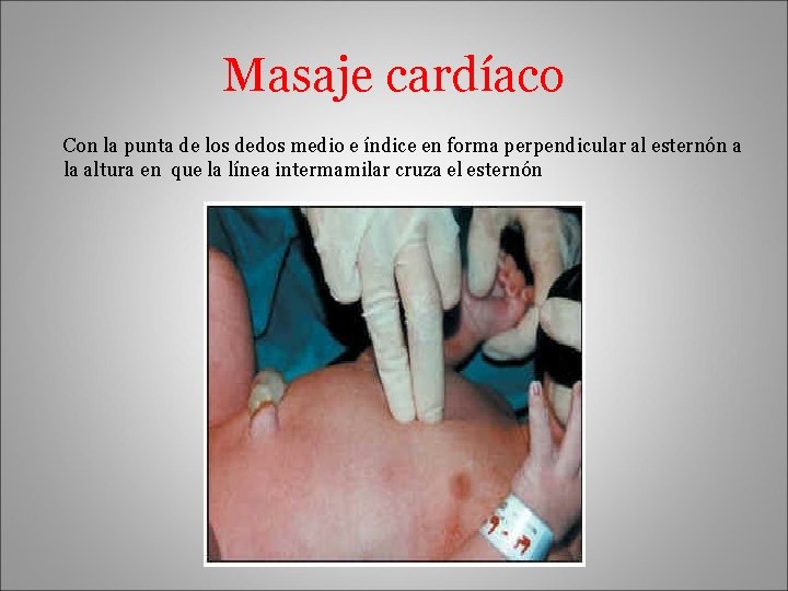 Masaje cardíaco Con la punta de los dedos medio e índice en forma perpendicular
