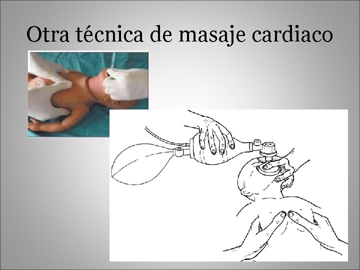 Otra técnica de masaje cardiaco 