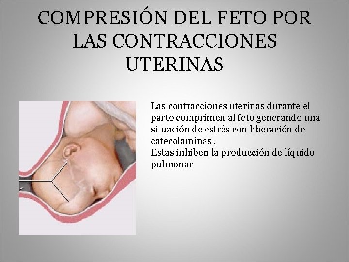 COMPRESIÓN DEL FETO POR LAS CONTRACCIONES UTERINAS Las contracciones uterinas durante el parto comprimen