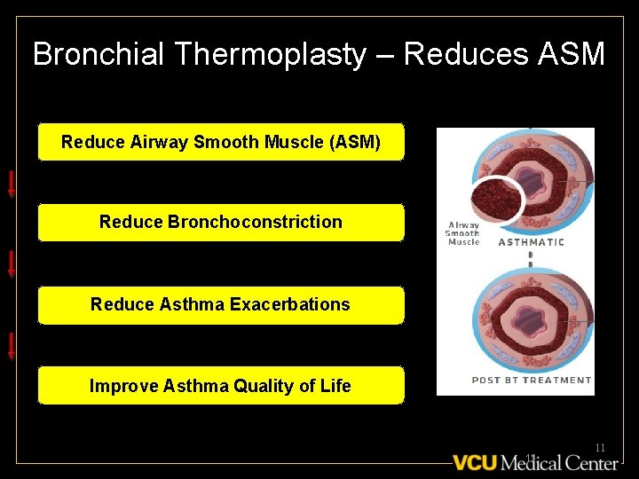 Bronchial Thermoplasty – Reduces ASM Reduce Airway Smooth Muscle (ASM) Reduce Bronchoconstriction Reduce Asthma