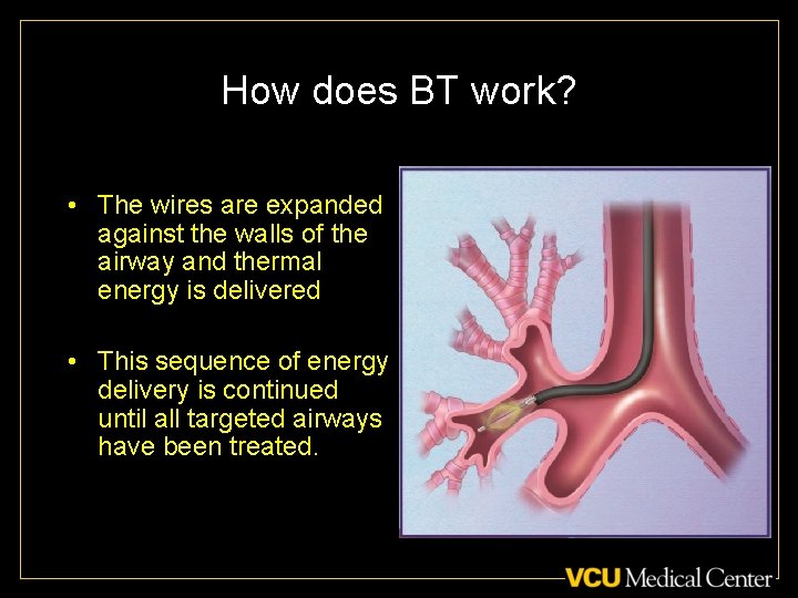 How does BT work? • The wires are expanded against the walls of the