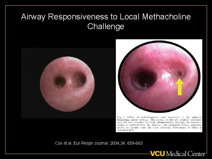 Airway Responsiveness to Local Methacholine Challenge Canine Model: Airway on left treated with bronchial