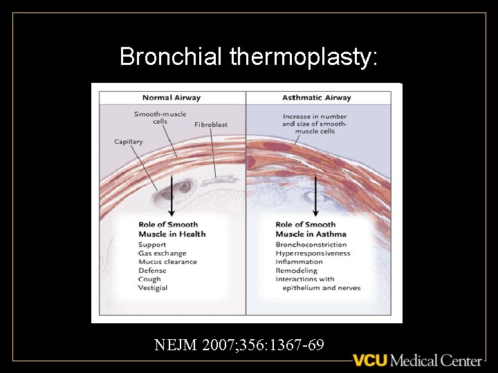 Bronchial thermoplasty: NEJM 2007; 356: 1367 -69 