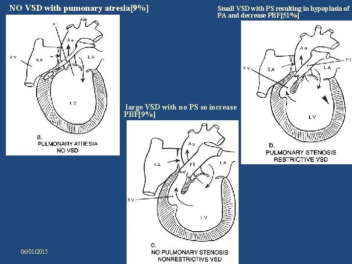 NO VSD with pumonary atresia[9%] Small VSD with PS resulting in hypoplasia of PA