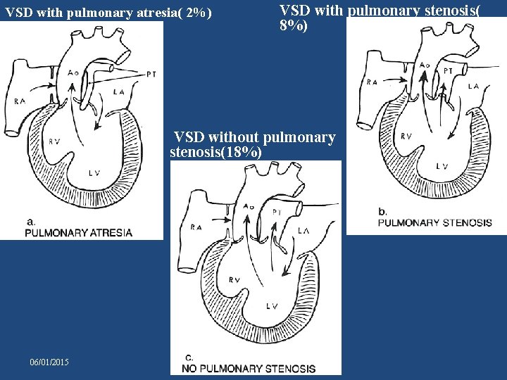 VSD with pulmonary atresia( 2%) VSD with pulmonary stenosis( 8%) VSD without pulmonary stenosis(18%)