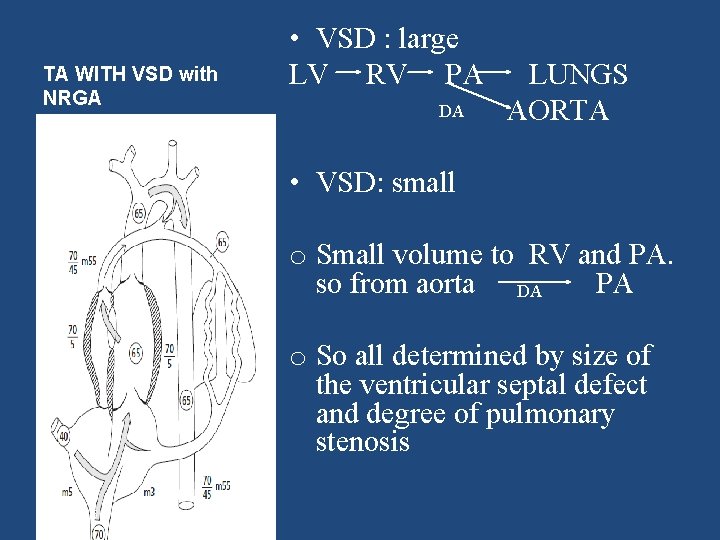 TA WITH VSD with NRGA • VSD : large LV RV PA DA LUNGS