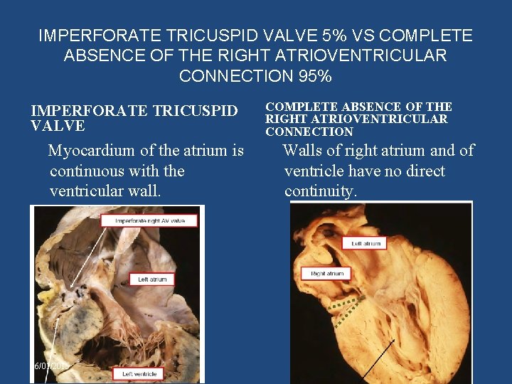 IMPERFORATE TRICUSPID VALVE 5% VS COMPLETE ABSENCE OF THE RIGHT ATRIOVENTRICULAR CONNECTION 95% IMPERFORATE