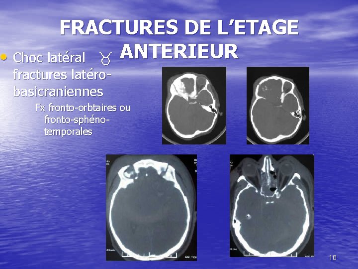 FRACTURES DE L’ETAGE • Choc latéral ANTERIEUR fractures latérobasicraniennes Fx fronto-orbtaires ou fronto-sphénotemporales 10