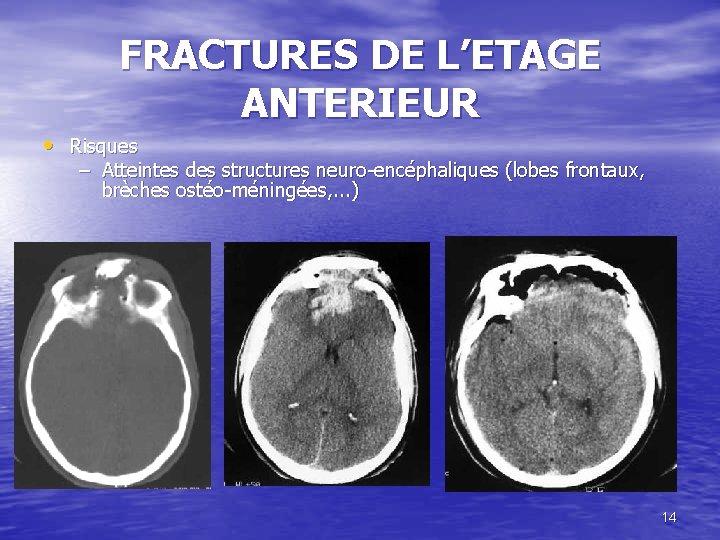 FRACTURES DE L’ETAGE ANTERIEUR • Risques – Atteintes des structures neuro-encéphaliques (lobes frontaux, brèches