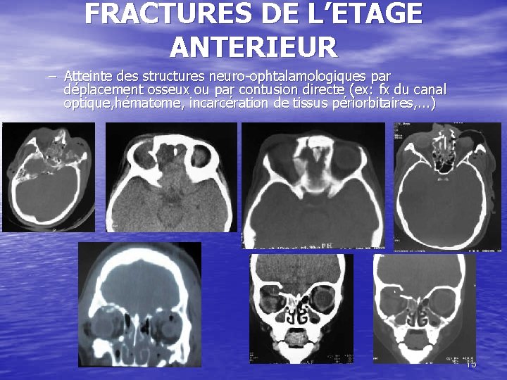 FRACTURES DE L’ETAGE ANTERIEUR – Atteinte des structures neuro-ophtalamologiques par déplacement osseux ou par