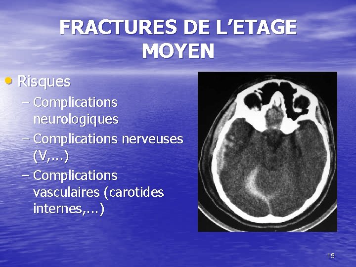 FRACTURES DE L’ETAGE MOYEN • Risques – Complications neurologiques – Complications nerveuses (V, .