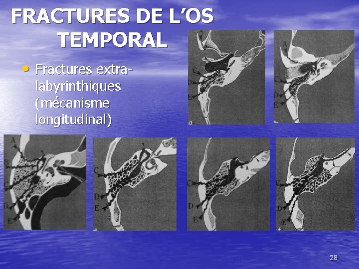 FRACTURES DE L’OS TEMPORAL • Fractures extralabyrinthiques (mécanisme longitudinal) 28 