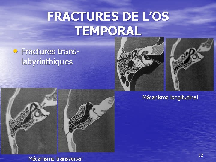 FRACTURES DE L’OS TEMPORAL • Fractures translabyrinthiques Mécanisme longitudinal Mécanisme transversal 32 