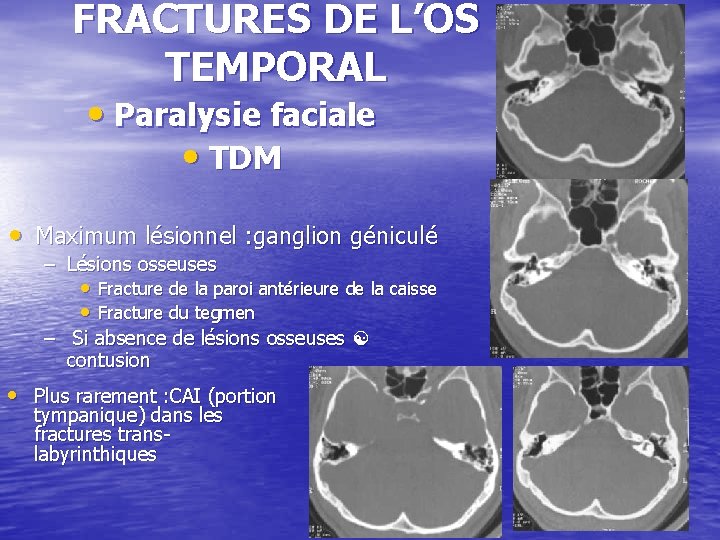 FRACTURES DE L’OS TEMPORAL • Paralysie faciale • TDM • Maximum lésionnel : ganglion