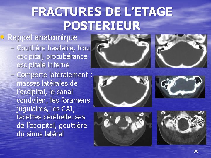 FRACTURES DE L’ETAGE POSTERIEUR • Rappel anatomique – Gouttière basilaire, trou occipital, protubérance occipitale