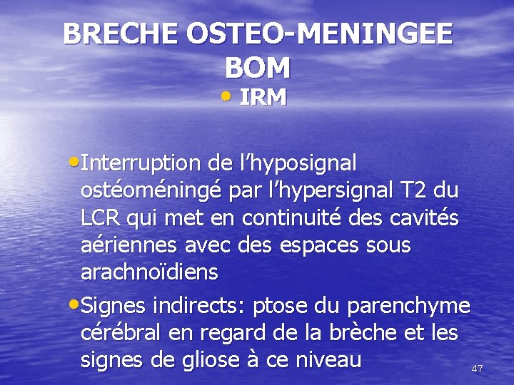 BRECHE OSTEO-MENINGEE BOM • IRM • Interruption de l’hyposignal ostéoméningé par l’hypersignal T 2
