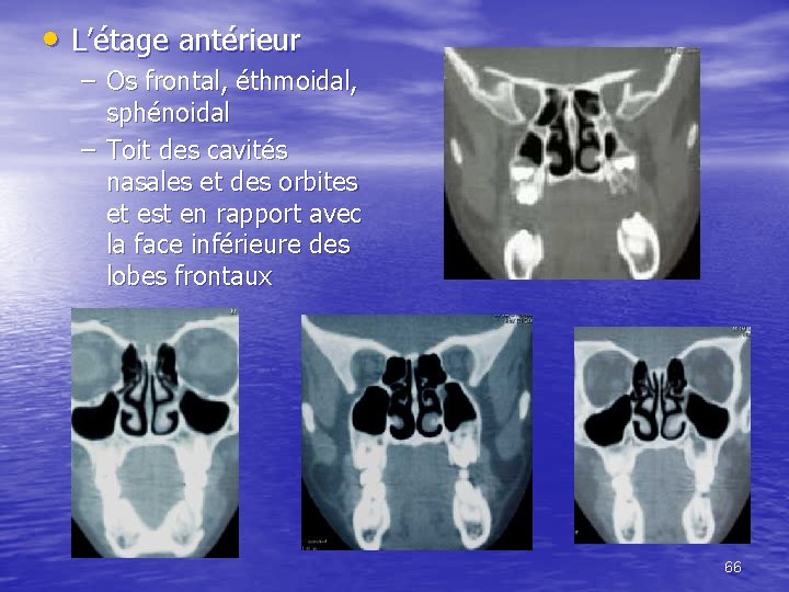  • L’étage antérieur – Os frontal, éthmoidal, sphénoidal – Toit des cavités nasales