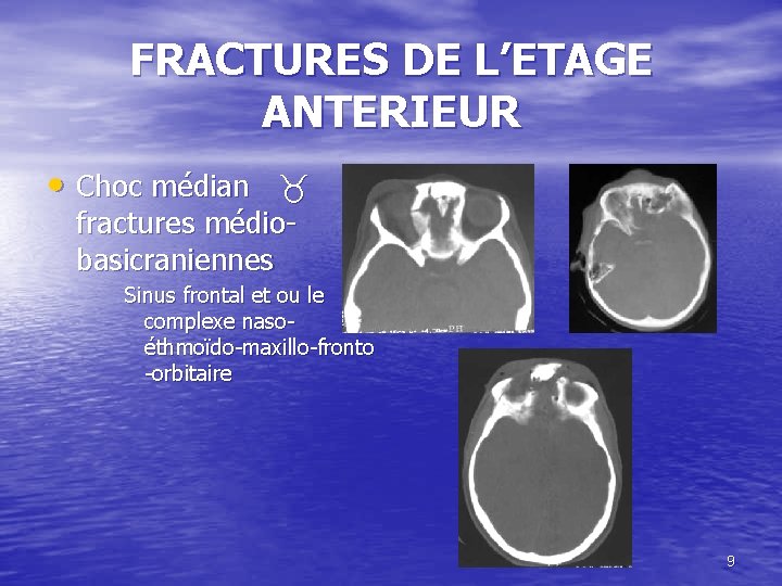 FRACTURES DE L’ETAGE ANTERIEUR • Choc médian fractures médiobasicraniennes Sinus frontal et ou le