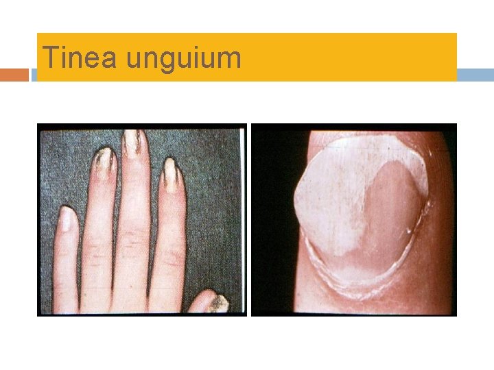 Tinea unguium 