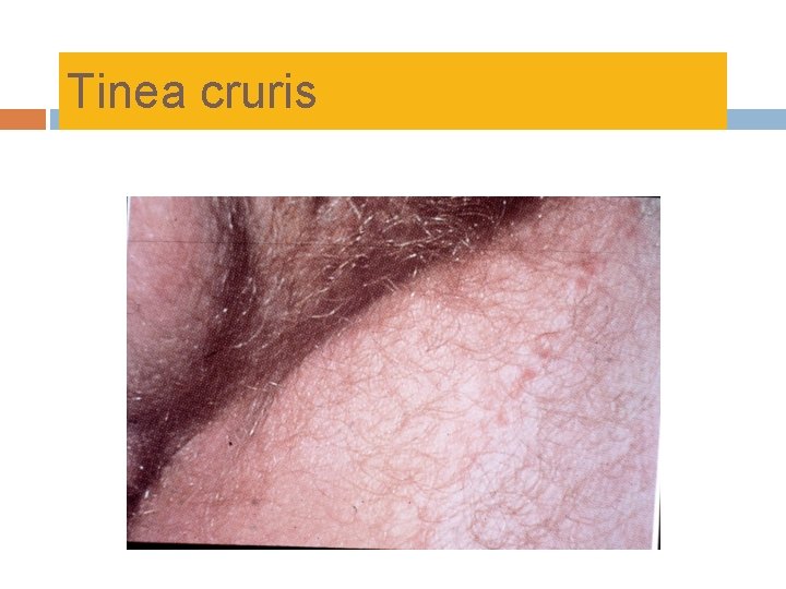 Tinea cruris 