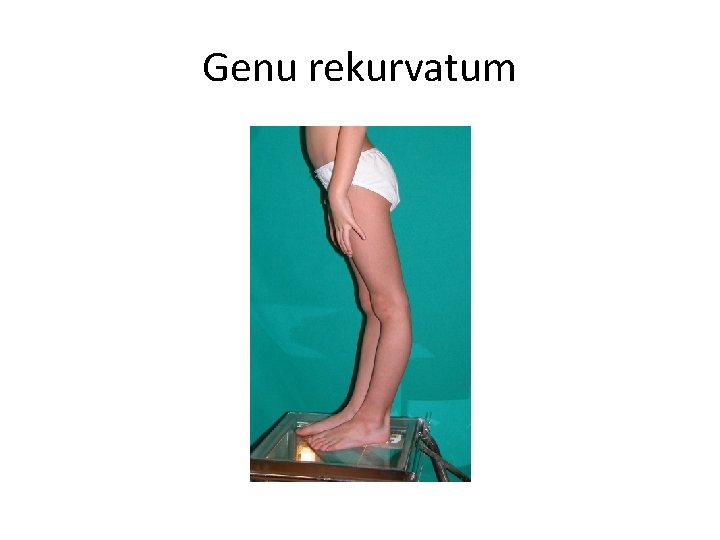 Genu rekurvatum 