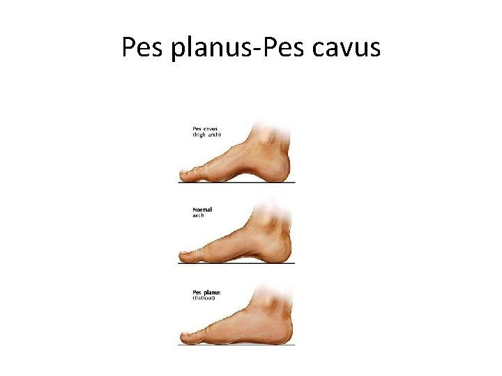 Pes planus-Pes cavus 