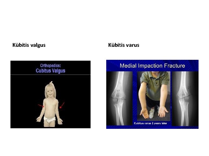 Kübitis valgus Kübitis varus 