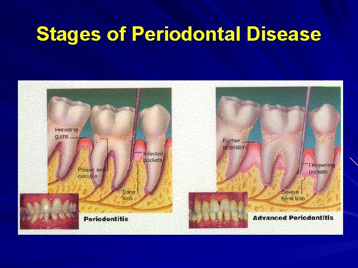 Stages of Periodontal Disease 