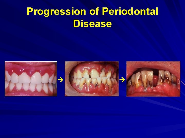 Progression of Periodontal Disease 