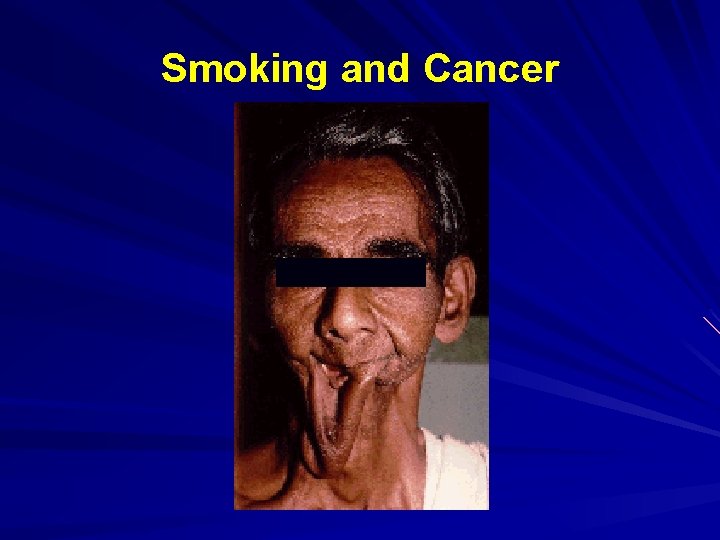 Smoking and Cancer 
