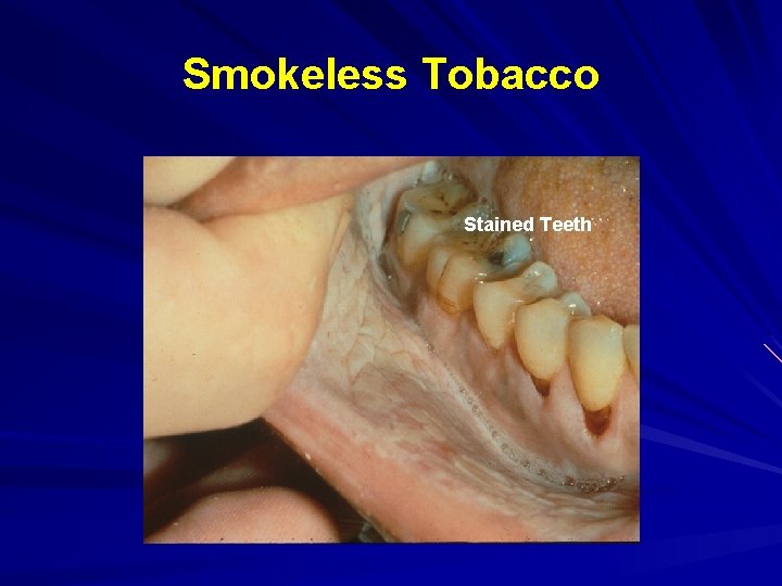 Smokeless Tobacco Stained Teeth 