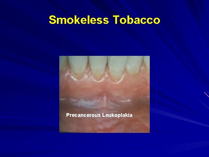 Smokeless Tobacco Precancerous Leukoplakia 