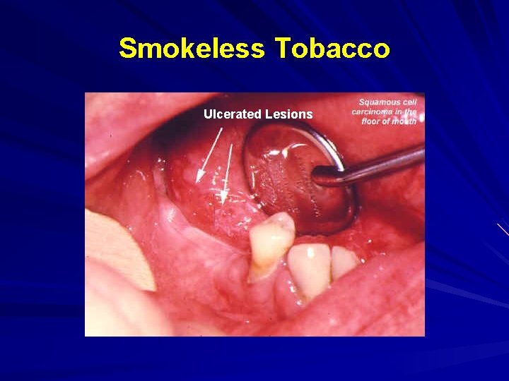 Smokeless Tobacco Ulcerated Lesions 