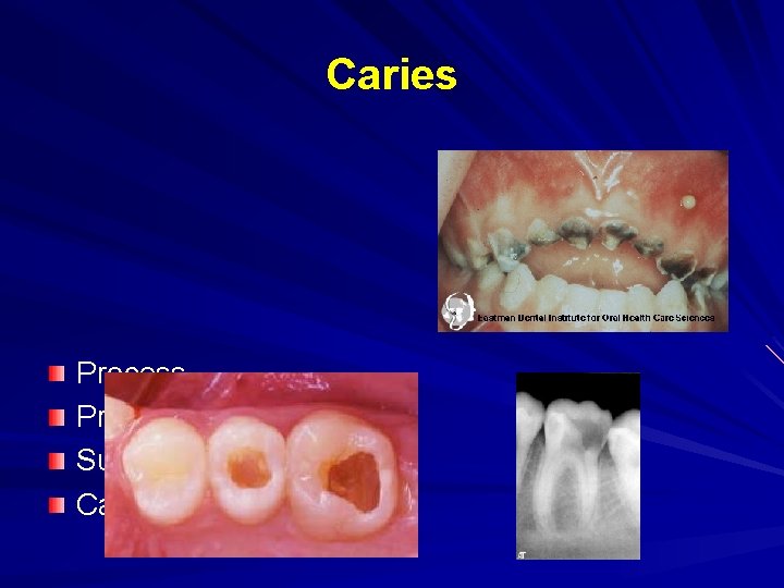 Caries Process Progression Sugar and Its Effects Caries Prevention 