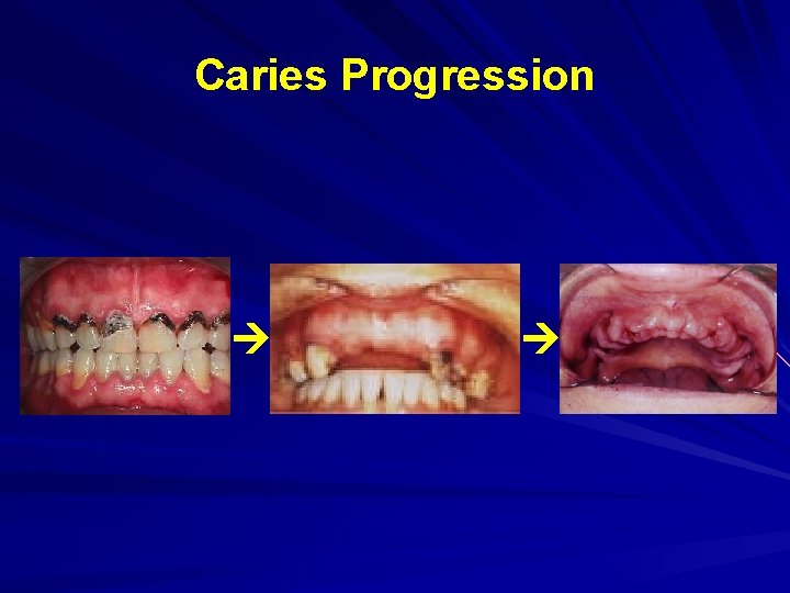 Caries Progression 