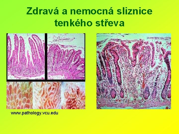 Zdravá a nemocná sliznice tenkého střeva www. pathology. vcu. edu 