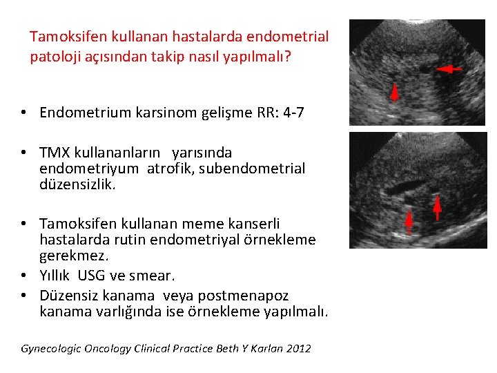 Tamoksifen kullanan hastalarda endometrial patoloji açısından takip nasıl yapılmalı? • Endometrium karsinom gelişme RR: