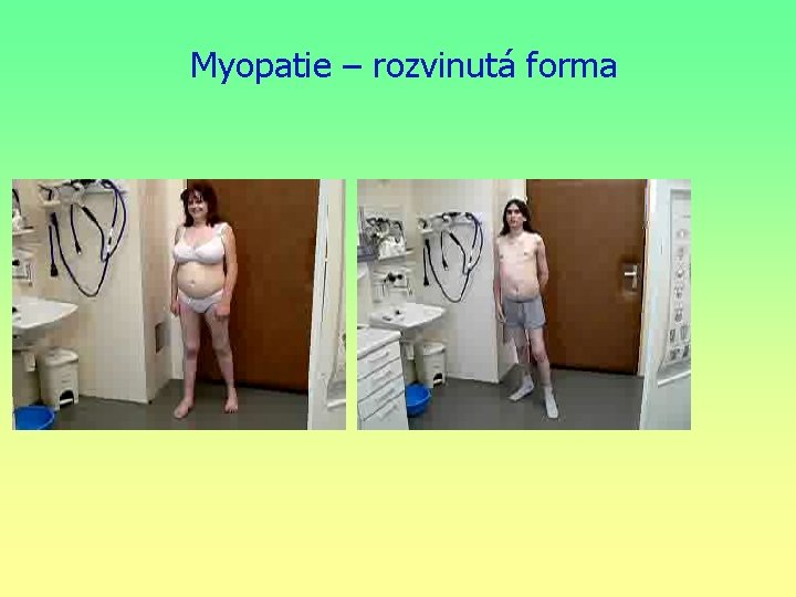 Myopatie – rozvinutá forma 