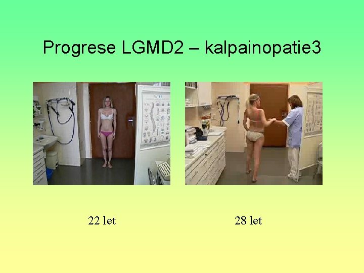 Progrese LGMD 2 – kalpainopatie 3 22 let 28 let 