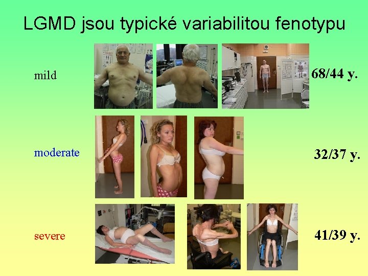 LGMD jsou typické variabilitou fenotypu mild 68/44 y. moderate 32/37 y. severe 41/39 y.