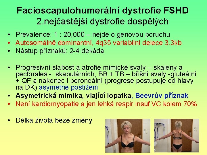 Facioscapulohumerální dystrofie FSHD 2. nejčastější dystrofie dospělých • Prevalence: 1 : 20, 000 –