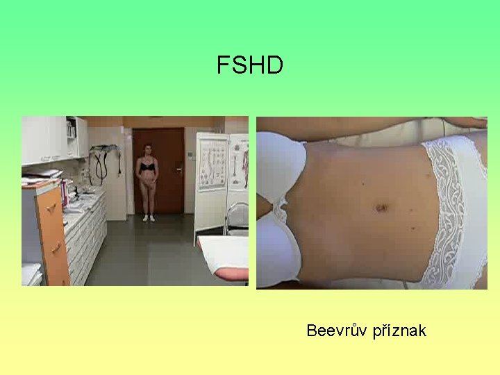 FSHD Beevrův příznak 